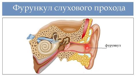 Лечение фурункула наружного слухового прохода